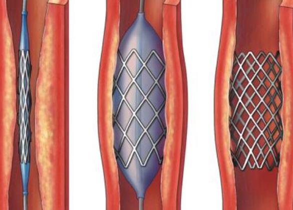 好消息！700元冠脈支架來(lái)了帶量采購(gòu)結(jié)果在甘肅省正式落地執(zhí)行